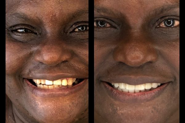 facette ceramique