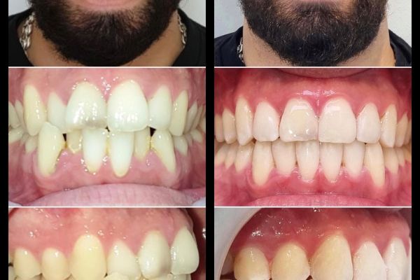 Invisalign