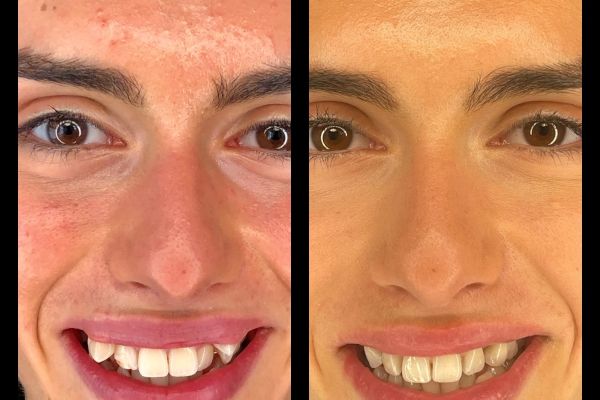 invisalign et couronne ceramique