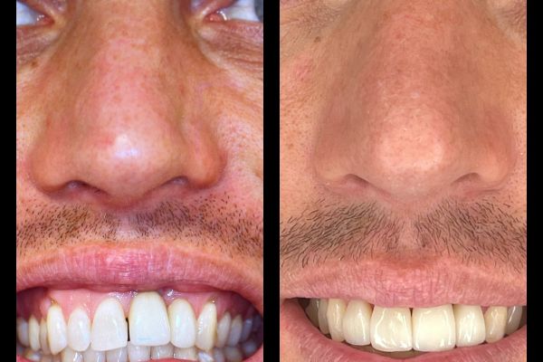 invisalign et facette ceramique