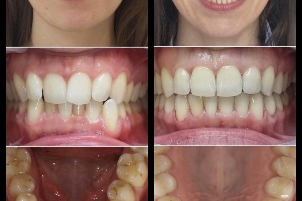 Invisalign