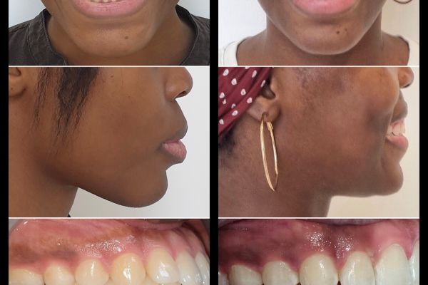 Invisalign