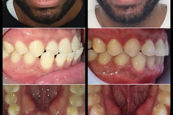Invisalign