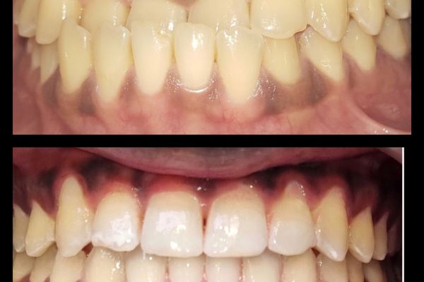 Invisalign