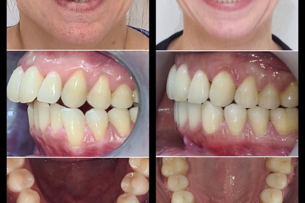 Invisalign