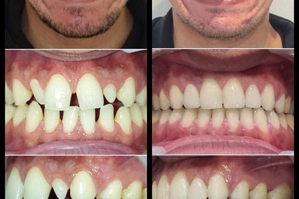Invisalign